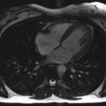 Archive cardiac MRI from October 2006, not a Corventis trial participant. Still frame from Bionerd, CC BY 3.0.
