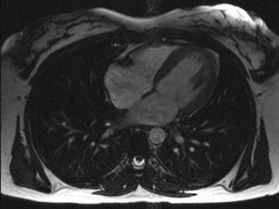 Archive cardiac MRI from October 2006, not a Corventis trial participant. Still frame from Bionerd, CC BY 3.0.