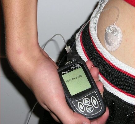 Archive photograph of an insulin pump and infusion set, not a device used in the Hybrid CATT1 study.
