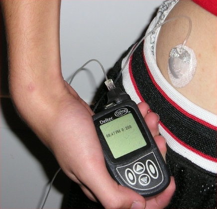 Archive photograph of an insulin pump and infusion set, not a device used in the Hybrid CATT1 study.