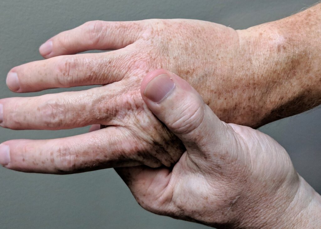 Archive photograph of a person massaging a painful hand. Illustrative, not identified as psoriatic arthritis or Ilumya treatment.
