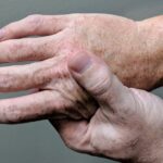 Archive photograph of a person massaging a painful hand. Illustrative, not identified as psoriatic arthritis or Ilumya treatment.