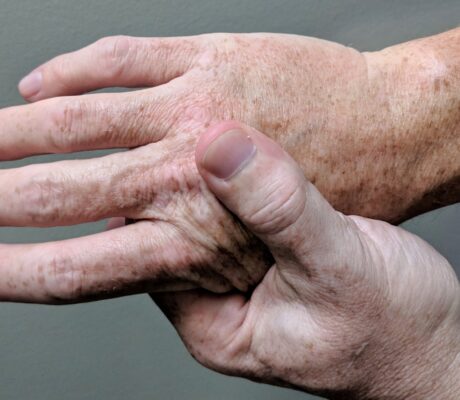 Archive photograph of a person massaging a painful hand. Illustrative, not identified as psoriatic arthritis or Ilumya treatment.
