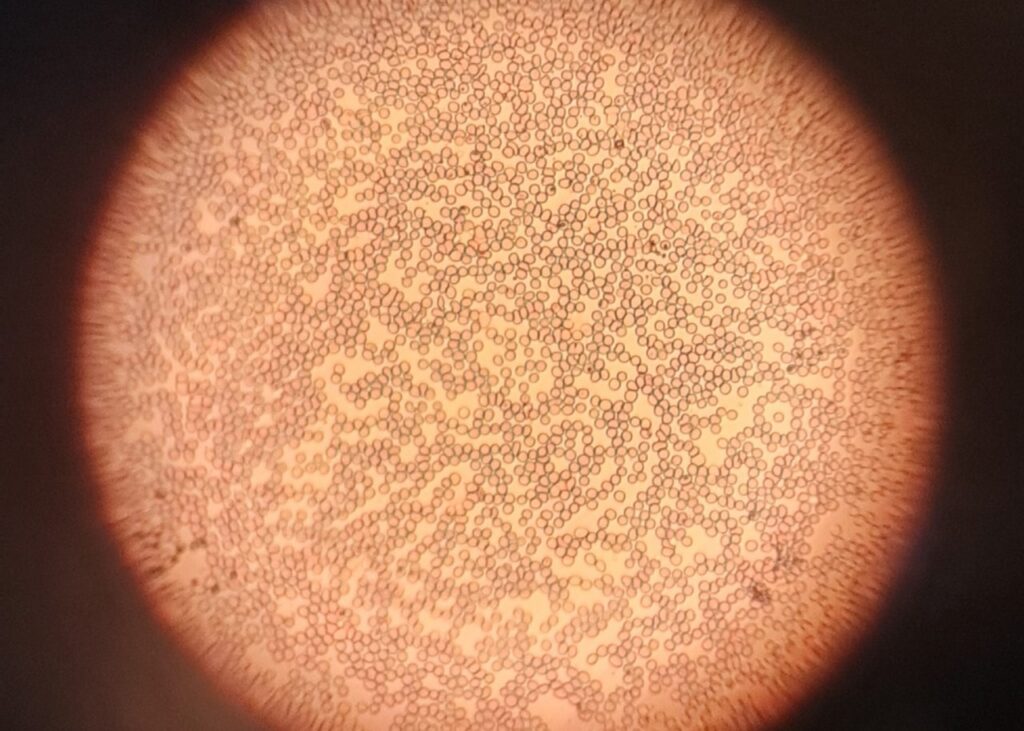 Archive micrograph of red blood cells, April2024, not a Casgevy patient or treatment image.