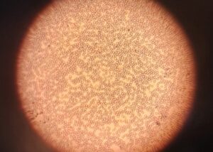 Archive micrograph of red blood cells, April2024, not a Casgevy patient or treatment image.
