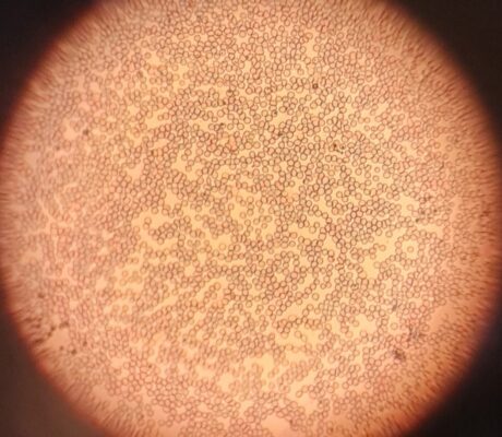 Archive micrograph of red blood cells, April2024, not a Casgevy patient or treatment image.